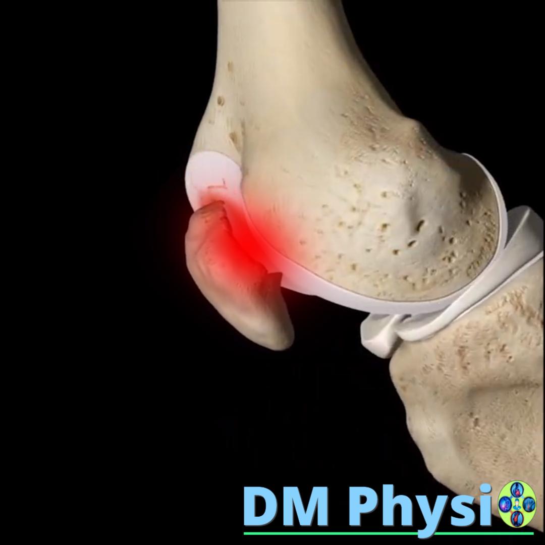 Пателофеморален синдром - визуализация
